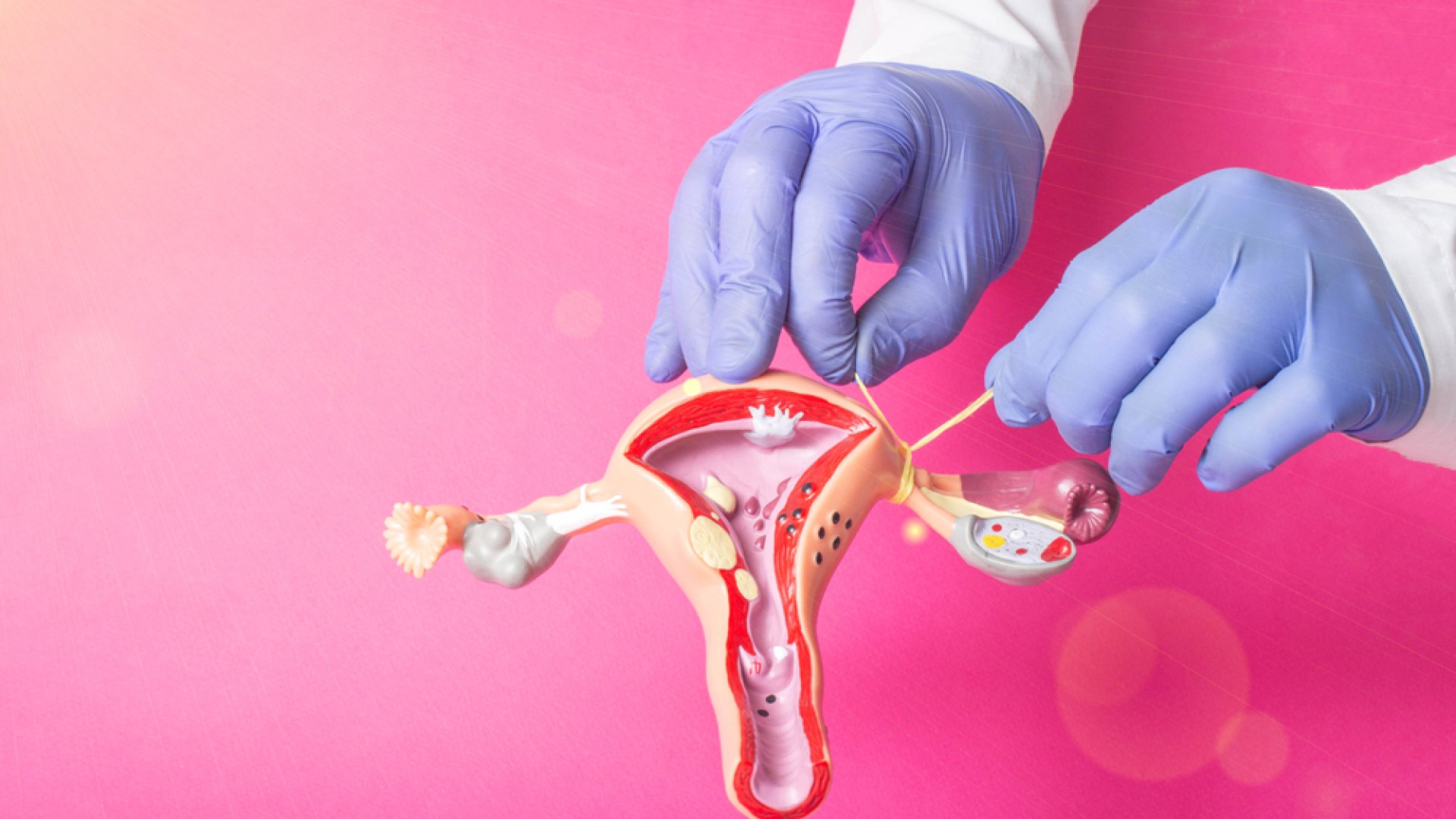 Sterilizáció nőknél Női sterilizáció